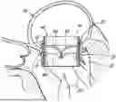 Fig. 01 - REPLACEMENT HEART VALVE SYSTEMS AND METHODS