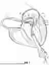 Fig. 02 - REPLACEMENT HEART VALVE SYSTEMS AND METHODS