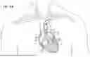 Fig. 17 - REPLACEMENT HEART VALVE SYSTEMS AND METHODS