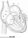 Fig. 18 - REPLACEMENT HEART VALVE SYSTEMS AND METHODS
