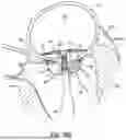 Fig. 21 - REPLACEMENT HEART VALVE SYSTEMS AND METHODS