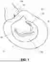 Fig. 02 - APPARATUS FOR USE IN REPAIRING MITRAL VALVES AND METHOD OF USE THEREOF