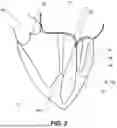 Fig. 03 - APPARATUS FOR USE IN REPAIRING MITRAL VALVES AND METHOD OF USE THEREOF