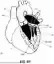 Fig. 14 - APPARATUS FOR USE IN REPAIRING MITRAL VALVES AND METHOD OF USE THEREOF