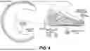 Fig. 04 - ORTHOPEDIC IMPLANTS HAVING CIRCUMFERENTIAL AND NON-CIRCUMFERENTIAL FIBERS