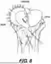 Fig. 08 - ORTHOPEDIC IMPLANTS HAVING CIRCUMFERENTIAL AND NON-CIRCUMFERENTIAL FIBERS