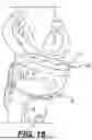 Fig. 16 - ORTHOPEDIC IMPLANTS HAVING CIRCUMFERENTIAL AND NON-CIRCUMFERENTIAL FIBERS