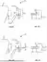Fig. 09 - ORTHODONTIC SYSTEMS WITH VARIABLE ATTACHMENT AND WELL GEOMETRIES