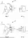 Fig. 10 - ORTHODONTIC SYSTEMS WITH VARIABLE ATTACHMENT AND WELL GEOMETRIES