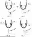 Fig. 02 - TRANSAPICAL VENTRICULAR MANIPULATION APPARATUS AND METHOD