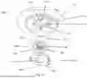 Fig. 13 - User-Friendly Junctional Tourniquet Device