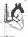 Fig. 01 - Cannula and Balloon System for Extracorporeal Membrane Oxygenation