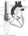 Fig. 22 - Cannula and Balloon System for Extracorporeal Membrane Oxygenation