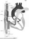 Fig. 33 - Cannula and Balloon System for Extracorporeal Membrane Oxygenation