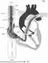 Fig. 35 - Cannula and Balloon System for Extracorporeal Membrane Oxygenation