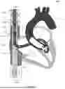 Fig. 40 - Cannula and Balloon System for Extracorporeal Membrane Oxygenation