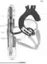Fig. 41 - Cannula and Balloon System for Extracorporeal Membrane Oxygenation