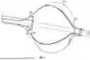 Fig. 04 - BALLOON-BASED DEVICE FOR CREATING INTERATRIAL SHUNT