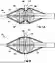 Fig. 06 - BALLOON-BASED DEVICE FOR CREATING INTERATRIAL SHUNT