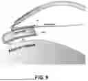 Fig. 15 - SYSTEMS AND METHODS FOR TREATMENT OF OBSTRUCTIVE SLEEP APNEA