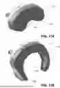 Fig. 17 - SYSTEMS AND METHODS FOR TREATMENT OF OBSTRUCTIVE SLEEP APNEA
