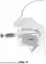 Fig. 22 - SYSTEMS AND METHODS FOR TREATMENT OF OBSTRUCTIVE SLEEP APNEA