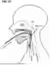 Fig. 35 - SYSTEMS AND METHODS FOR TREATMENT OF OBSTRUCTIVE SLEEP APNEA