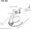Fig. 45 - SYSTEMS AND METHODS FOR TREATMENT OF OBSTRUCTIVE SLEEP APNEA