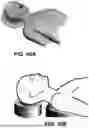 Fig. 53 - SYSTEMS AND METHODS FOR TREATMENT OF OBSTRUCTIVE SLEEP APNEA