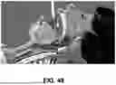 Fig. 71 - SYSTEMS AND METHODS FOR TREATMENT OF OBSTRUCTIVE SLEEP APNEA