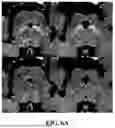 Fig. 07 - METHOD FOR SIMULTANEOUS IMAGING AND IMAGE PROCESSING OF NEUROMELANIN AND NIGROSOME 1 USING 3D MULTI-ECHO GRE