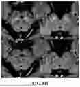 Fig. 08 - METHOD FOR SIMULTANEOUS IMAGING AND IMAGE PROCESSING OF NEUROMELANIN AND NIGROSOME 1 USING 3D MULTI-ECHO GRE