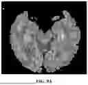 Fig. 13 - METHOD FOR SIMULTANEOUS IMAGING AND IMAGE PROCESSING OF NEUROMELANIN AND NIGROSOME 1 USING 3D MULTI-ECHO GRE