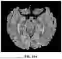 Fig. 15 - METHOD FOR SIMULTANEOUS IMAGING AND IMAGE PROCESSING OF NEUROMELANIN AND NIGROSOME 1 USING 3D MULTI-ECHO GRE