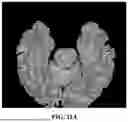 Fig. 17 - METHOD FOR SIMULTANEOUS IMAGING AND IMAGE PROCESSING OF NEUROMELANIN AND NIGROSOME 1 USING 3D MULTI-ECHO GRE