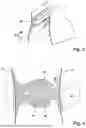 Fig. 04 - RETRIEVE DEVICE AND METHOD FOR RETRIEVING TISSUE