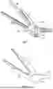 Fig. 09 - SYSTEM FOR LEFT ATRIAL APPENDAGE CLIP