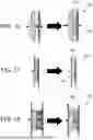Fig. 22 - OCCLUDER INCLUDING EXTERNAL SKIRT