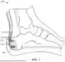 Fig. 07 - MINIMALLY INVASIVE SURGICAL METHOD FOR HAGLUND'S DEFORMITY AND PARATENON PRESERVATION