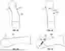 Fig. 02 - JIGS AND RELATED METHODS FOR GUIDING A CUTTING INSTRUMENT FOR CONTROLLED SURGICAL CUTTING OF A BODY PORTION OF A PATIENT