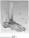 Fig. 02 - PATIENT-SPECIFIC TEMPLATE FOR TOTAL ANKLE REPLACEMENT