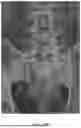 Fig. 06 - INSTRUMENT KIT FOR TRANSOSSEOUS UPPER HYPOGASTRIC PLEXUS NEUROLYTIC BLOCKADE
