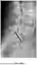 Fig. 07 - INSTRUMENT KIT FOR TRANSOSSEOUS UPPER HYPOGASTRIC PLEXUS NEUROLYTIC BLOCKADE