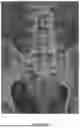 Fig. 08 - INSTRUMENT KIT FOR TRANSOSSEOUS UPPER HYPOGASTRIC PLEXUS NEUROLYTIC BLOCKADE