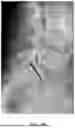 Fig. 09 - INSTRUMENT KIT FOR TRANSOSSEOUS UPPER HYPOGASTRIC PLEXUS NEUROLYTIC BLOCKADE