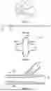 Fig. 05 - POSTPARTUM UTERINE HEMORRHAGE DEVICE