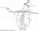 Fig. 35 - MINIMALLY-INVASIVE SLICING