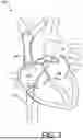 Fig. 03 - CONDUCTIVE MEMBER TO PROMOTE INSULATIVE MEDIUM FORMATION FOR FACILITATING TISSUE PUNCTURE IN A LIQUID MEDIUM