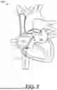 Fig. 03 - TISSUE VAPORIZATION DEVICE WITH PERMEABLE DISTAL CONDUCTIVE SECTION