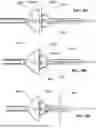 Fig. 22 - TRANSCATHETER DEVICE FOR INTERATRIAL ANASTOMOSIS